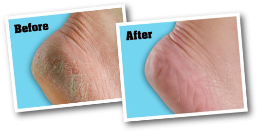 Healthy feet creme fra O'Keeffe's - før og efter billede