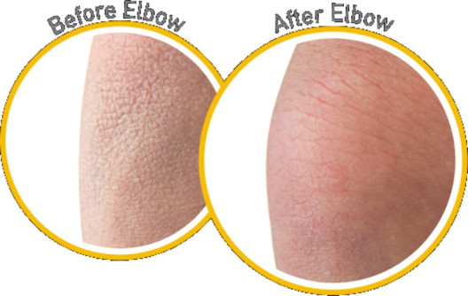 Skin Repair - body lotion - før og efter billede Skin Repair - body lotion - før og efter billede